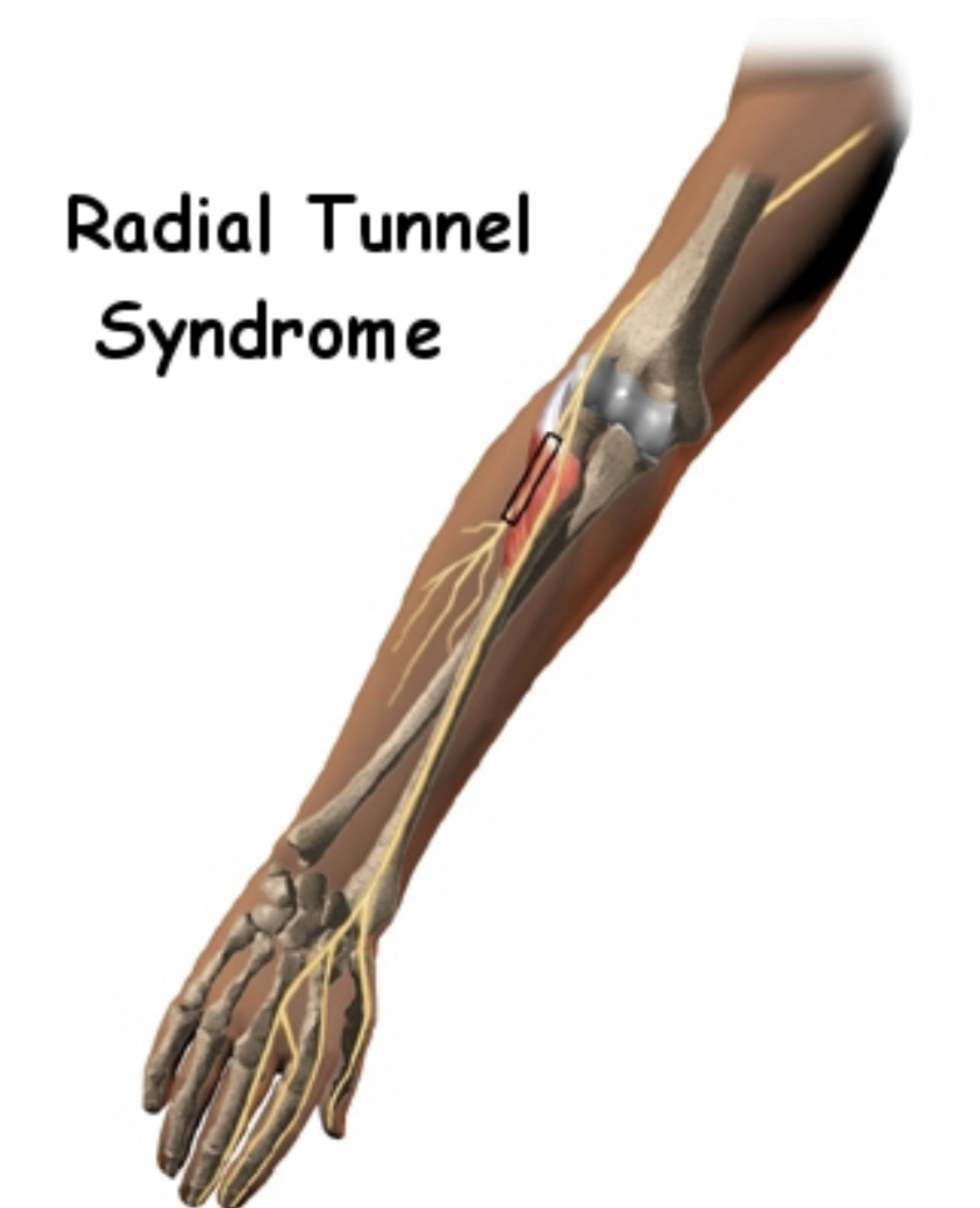 Radial Tunnel