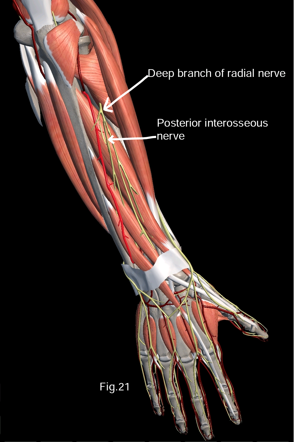 Posterior Interosseous Artery