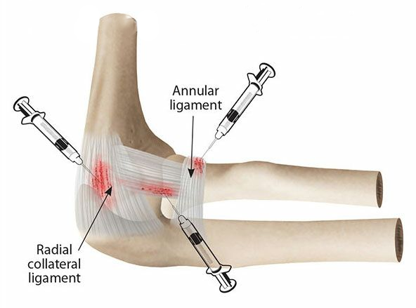 Elbow Injection and Nerve Compression In The Elbow