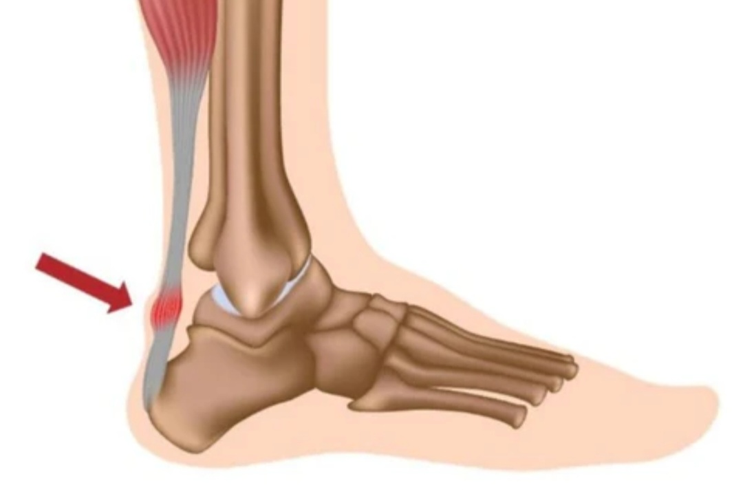 Plantar Aponeurosis Clinical Relevance